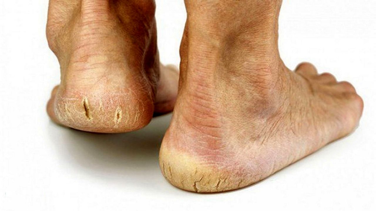 ۶ دلیل اصلی بروز ترک در پاشنه پا را بهتر بشناسید