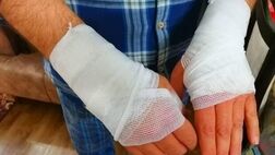 بیمه سلامت هزینه سوختگی را چگونه پوشش می‌دهد
