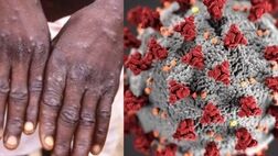 احتمال انتقال آبله میمونی قبل از ظهور علائم