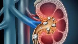 سنگ کلیه و علت تشکیل آن چیست ؟